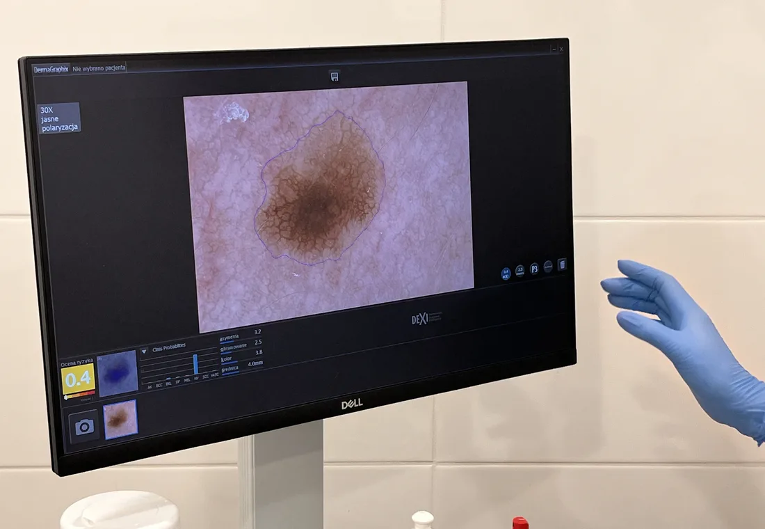 Obraz znamienia widoczny na ekranie wideodermatoskopu